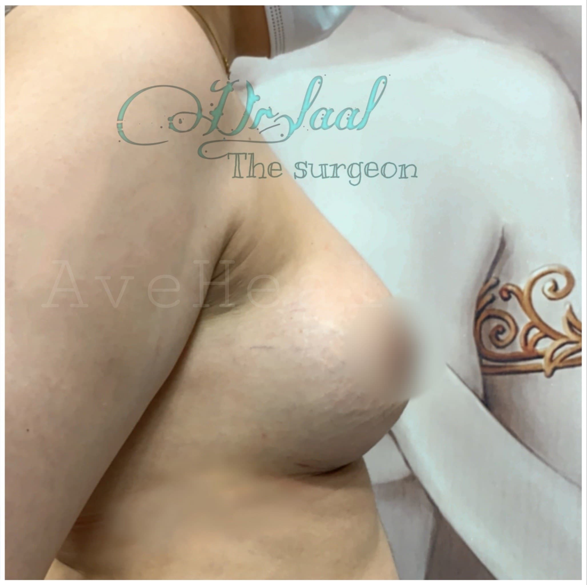 after-breast-lift-and-augmentation-dr-homeira-laal-khosh-ab